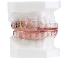 Oral appliance on smile mmodel