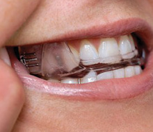 Closeup of smile with oral appliance in place