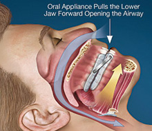 appliance oral therapy sleep apnea works