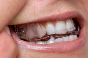 Closeup of smile with oral appliance